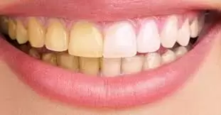 Treatment of yellow teeth