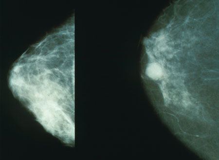 صورة أشعة سينية تبين شكل الورم السرطاني في الثدي (يمين) والثدي الطبيعي (يسار(