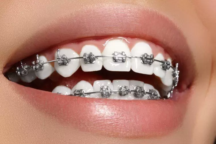 تقويم الأسنان المعدني