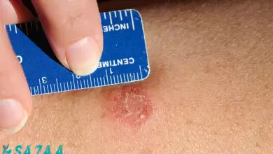 ringworm of the skin