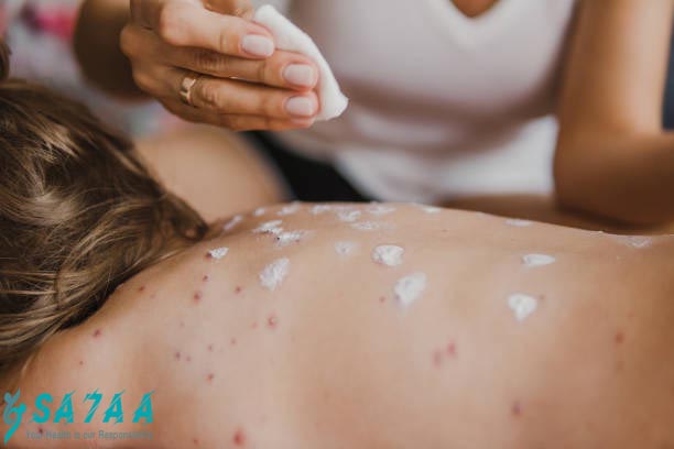 rubella