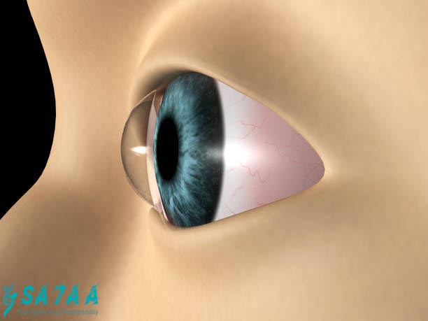 keratoconus